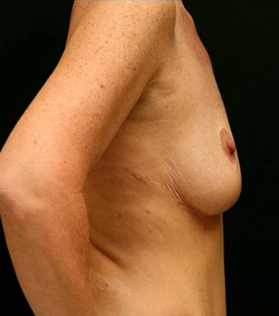 Breast Augmentation