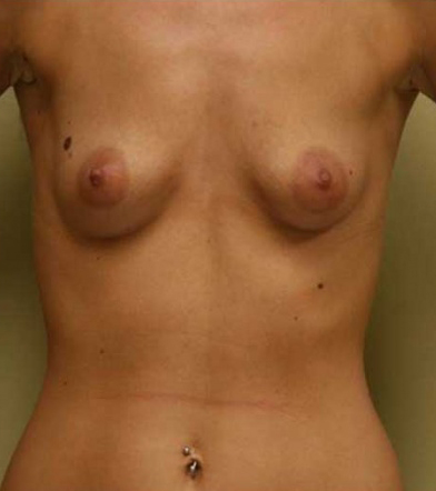Breast Augmentation