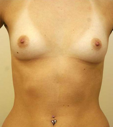 Breast Augmentation