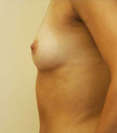 Breast Augmentation