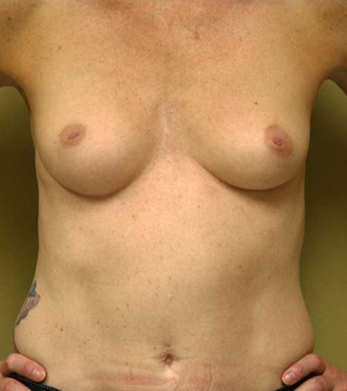 Breast Augmentation