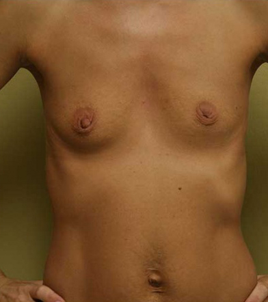 Breast Augmentation
