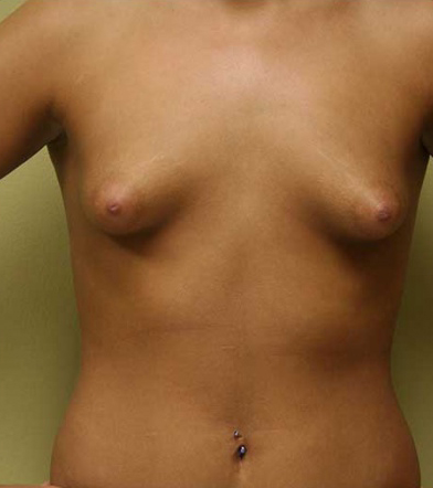 Breast Augmentation