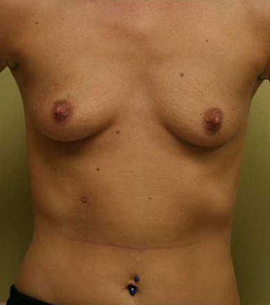 Breast Augmentation