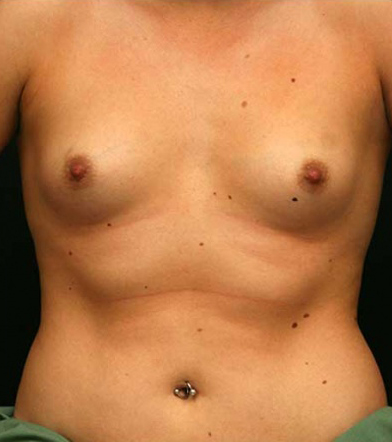 Breast Augmentation