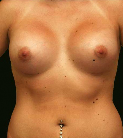 Breast Augmentation