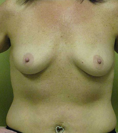 Breast Augmentation
