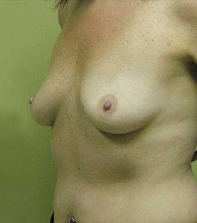 Breast Augmentation