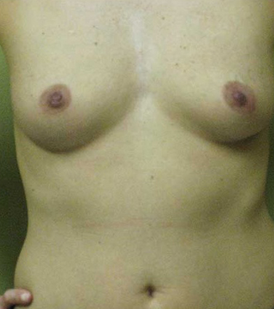 Breast Augmentation