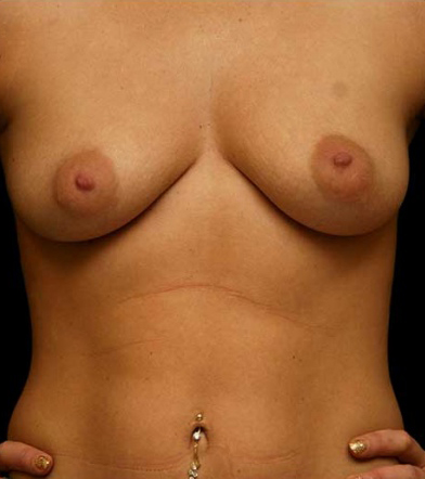 Breast Augmentation