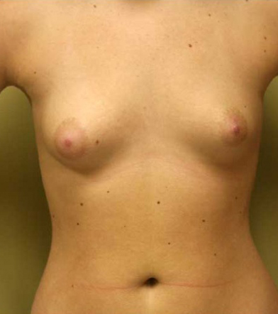Breast Augmentation
