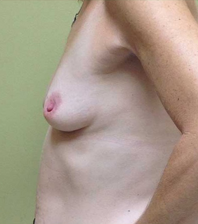 Breast Augmentation