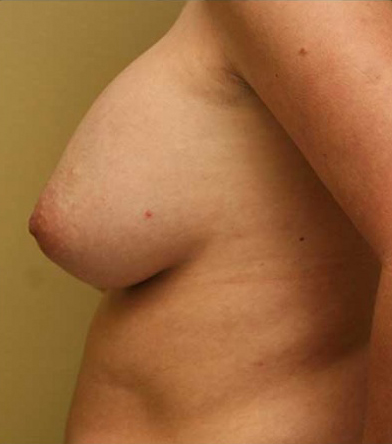 Breast Augmentation