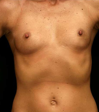 Breast Augmentation