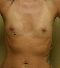 Breast Augmentation - 300cc and under