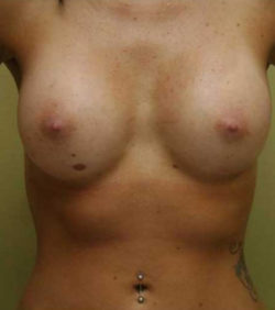 Breast Augmentation - 300cc and under