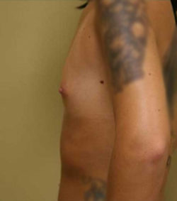 Breast Augmentation - 300cc and under