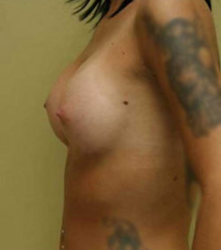 Breast Augmentation - 300cc and under