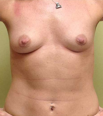 Breast Augmentation
