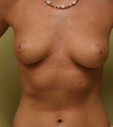 Breast Augmentation