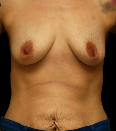 Breast Augmentation