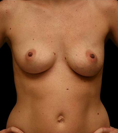 Breast Augmentation