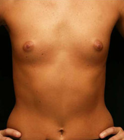 Breast Augmentation