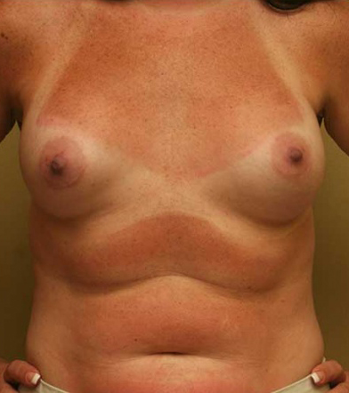 Breast Augmentation