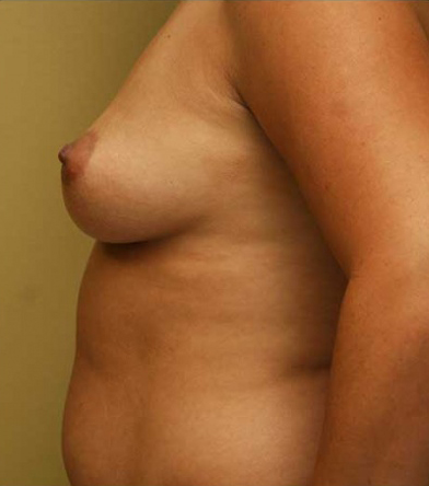 Breast Augmentation