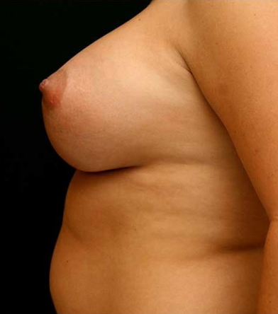 Breast Augmentation