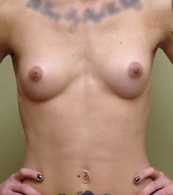 Breast Augmentation