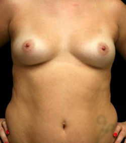 Breast Augmentation