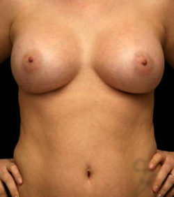 Breast Augmentation