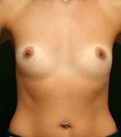 Breast Augmentation