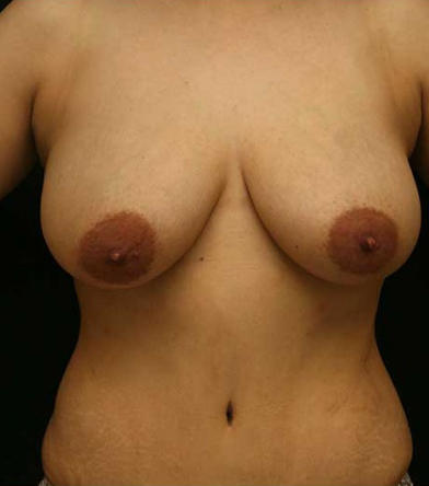 Breast Lift Before & After Results