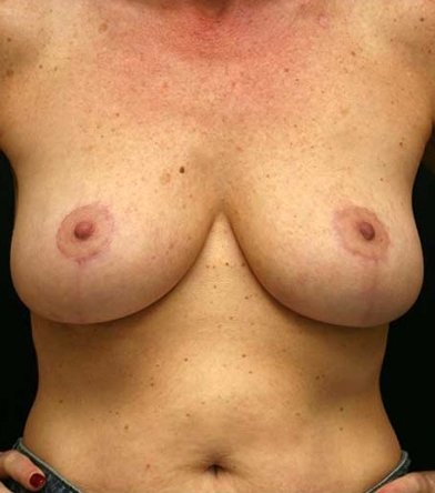 Breast Lift