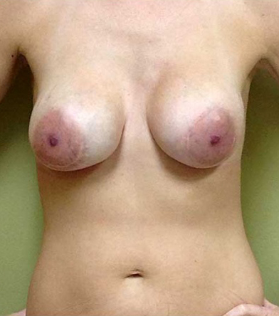 Breast Lift