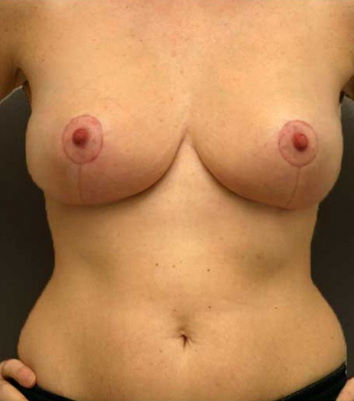 Breast Lift