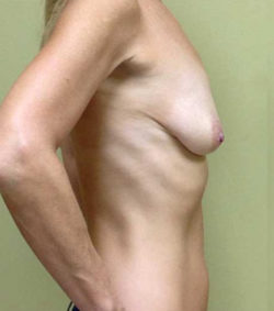 Breast Lift