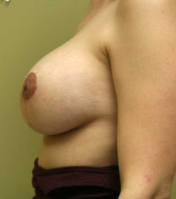 Breast Lift