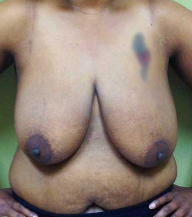 Breast Lift
