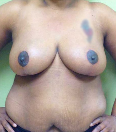 Breast Lift