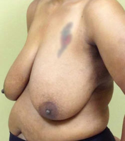 Breast Lift