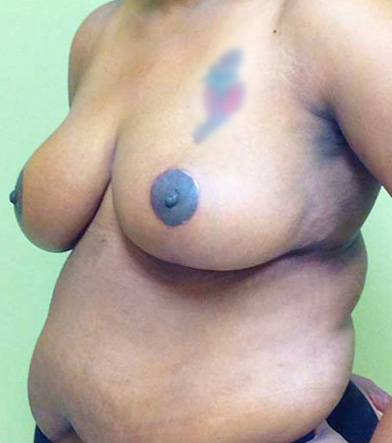 Breast Lift