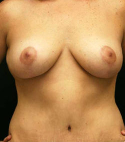 Breast Lift