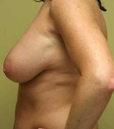 Breast Lift
