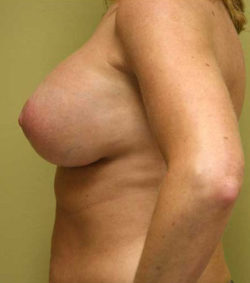 Breast Lift