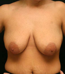 Breast Lift