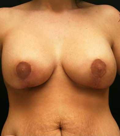 Breast Lift