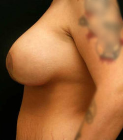 Breast Lift